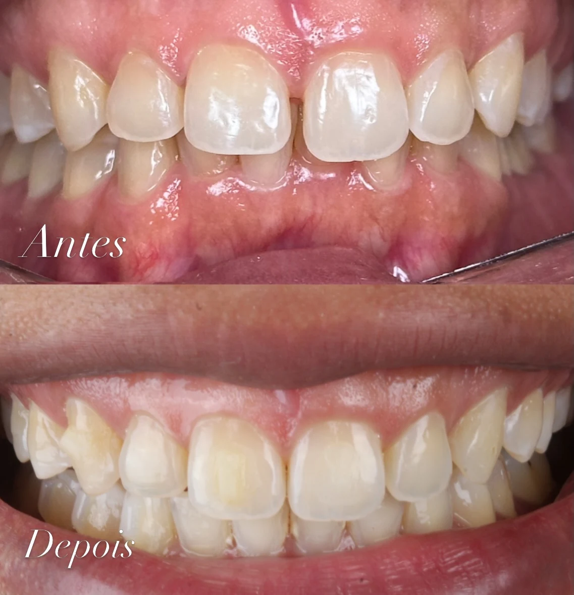 Antes e depois de um caso tratado com alinhadores