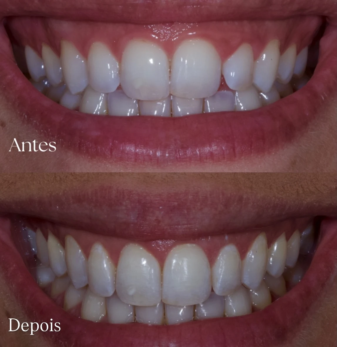Antes e depois de um caso tratado: dentes desalinhados, e depois nivelados